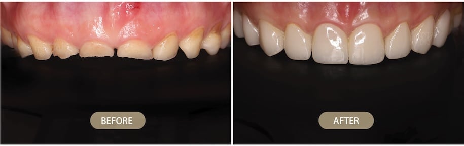 CEREC 一日修復改善前牙磨損與牙齒外觀的前後對比