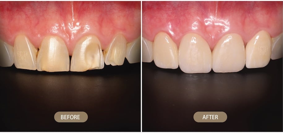 CEREC 一日修復重建前牙型態與牙齒美觀的前後對比