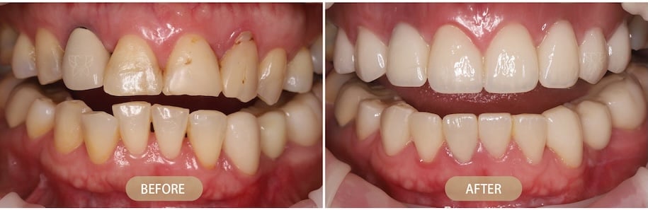 CEREC 一日全瓷修復改善牙齒磨損與咬合外觀的前後對比