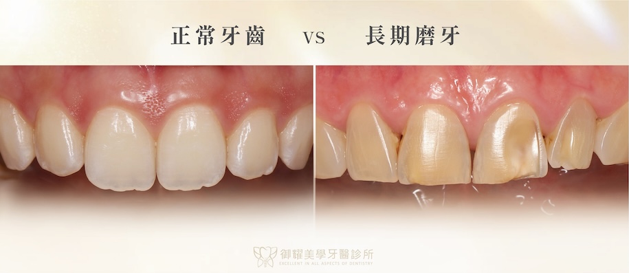 正常牙齒與長期磨牙造成牙齒磨損的對比示意圖