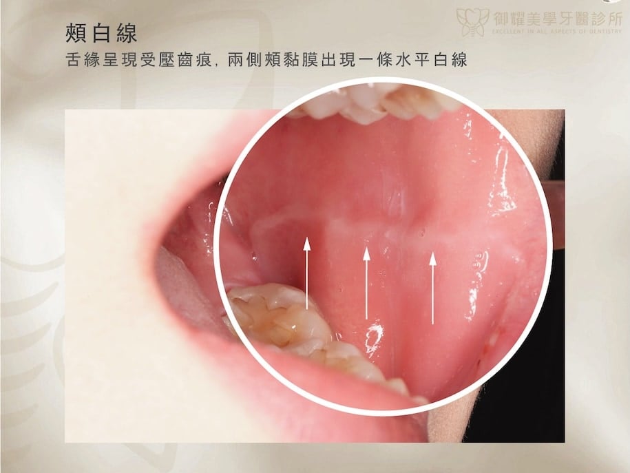 磨牙造成頰白線的口腔內側示意圖