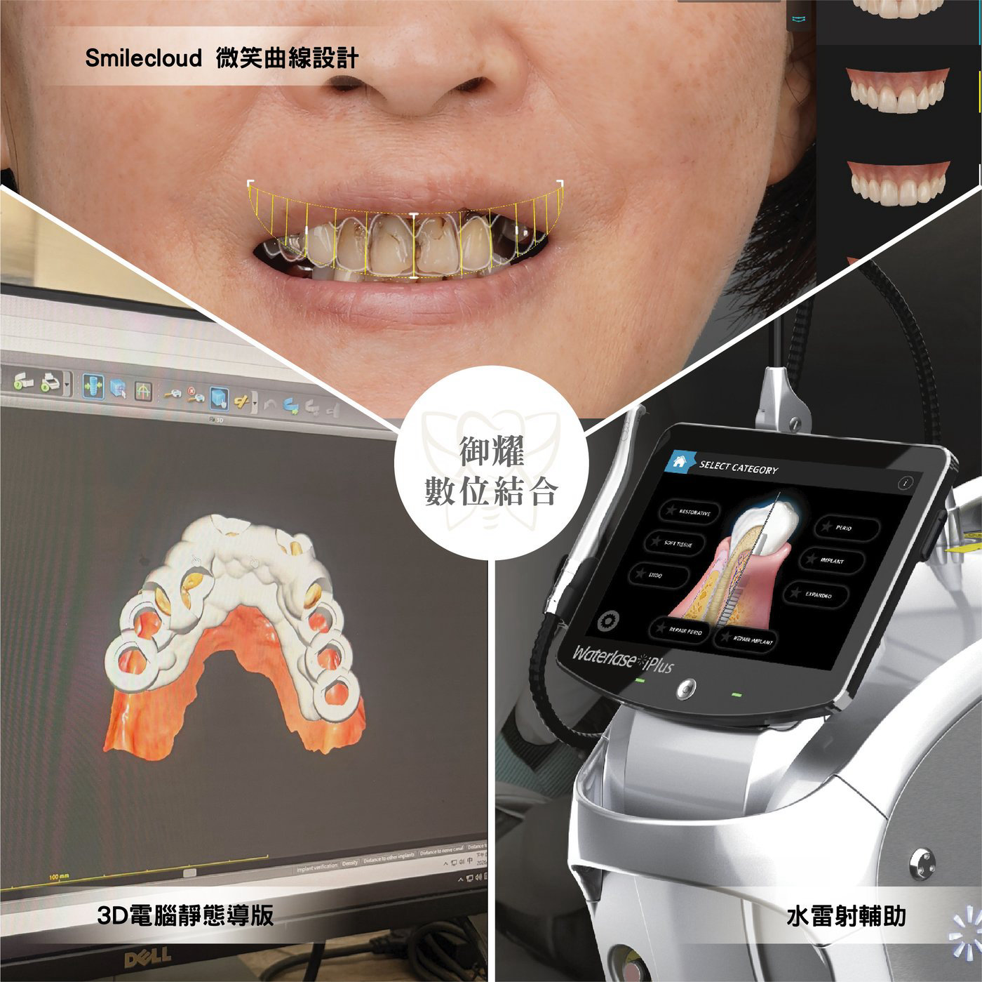 御耀美學全口重建技術：結合微笑設計、3D電腦導板與水雷射輔助