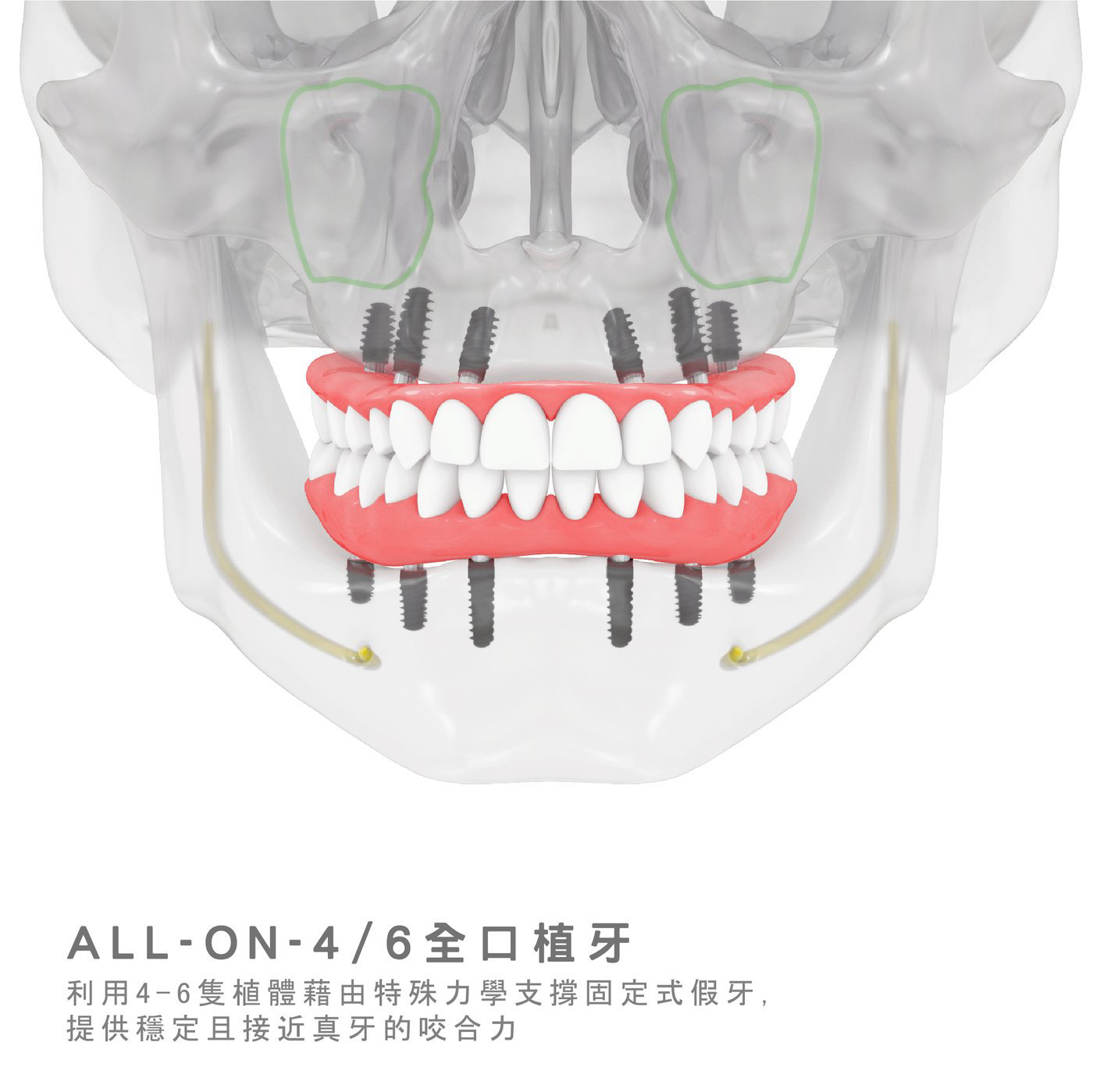 All-on-4全口植牙與固定式假牙示意圖