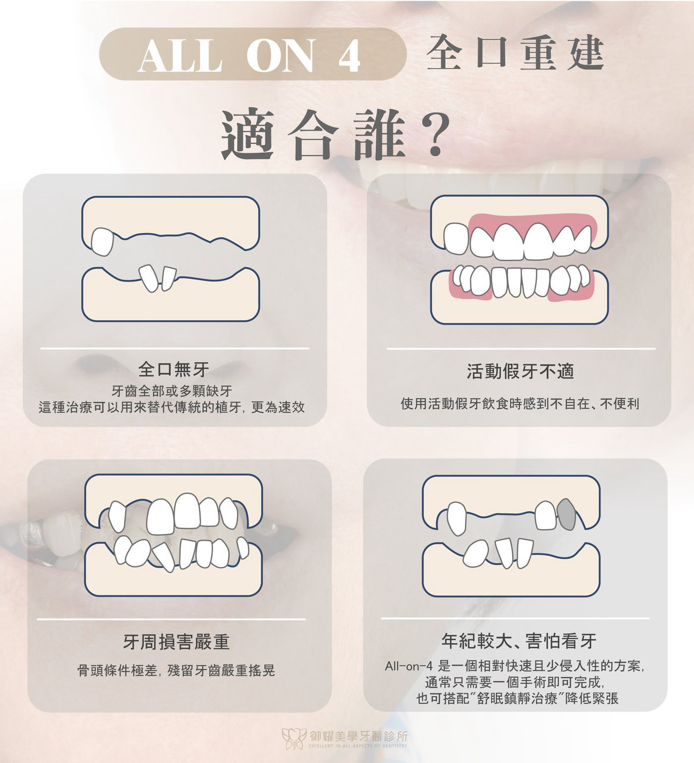 All-on-4全口重建適合對象示意圖