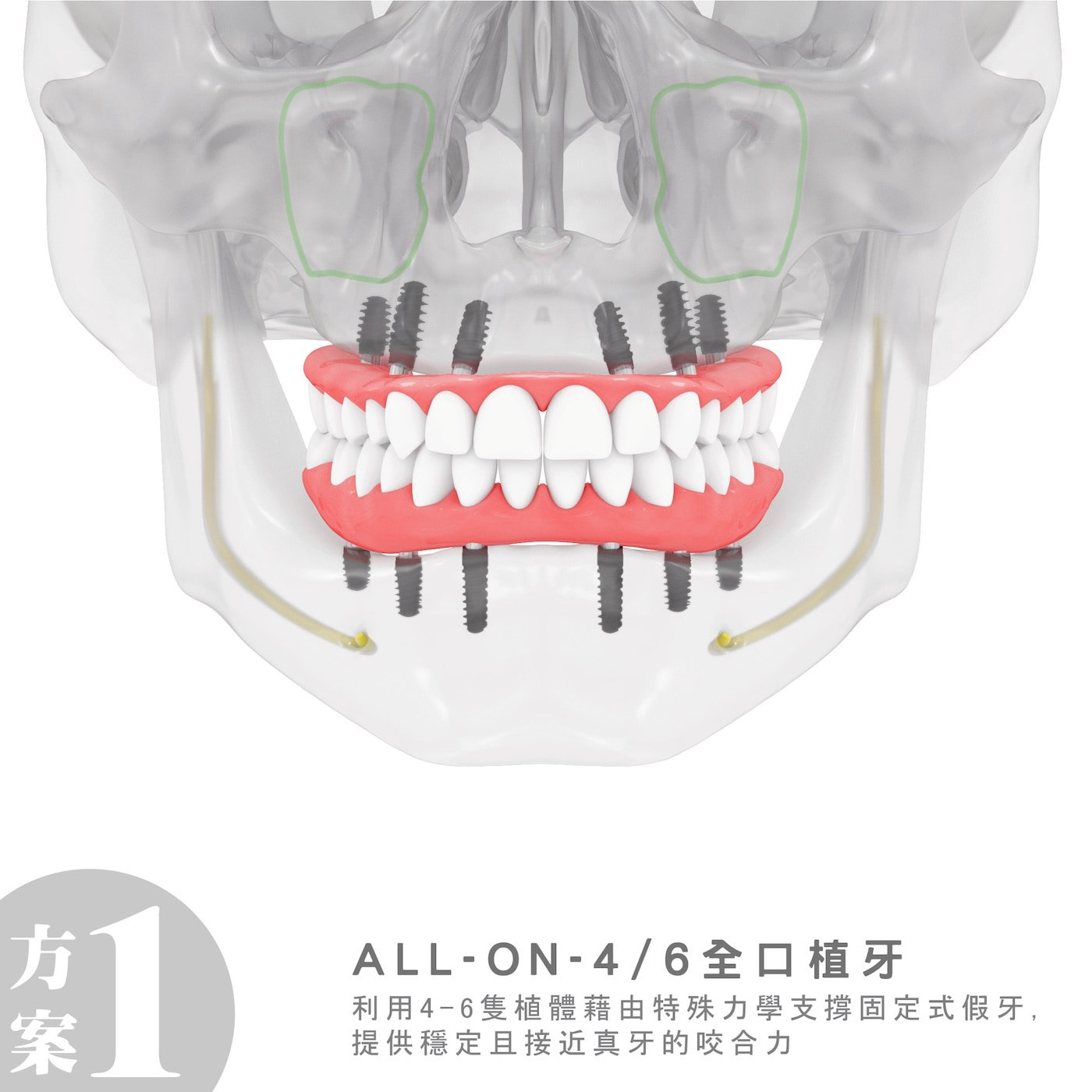 All-on-4全口植牙治療方式示意圖